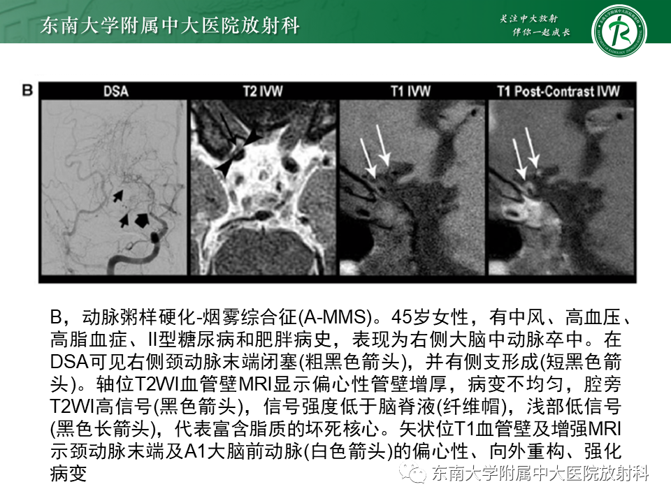 影像PPT - 【PPT】烟雾病-27