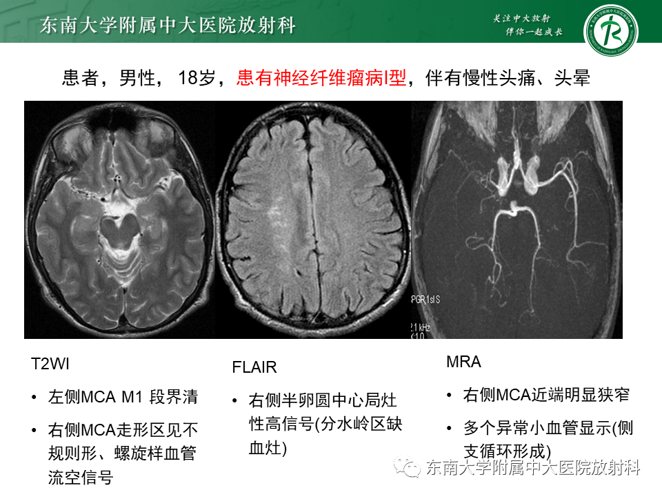 影像PPT - 【PPT】烟雾病-29