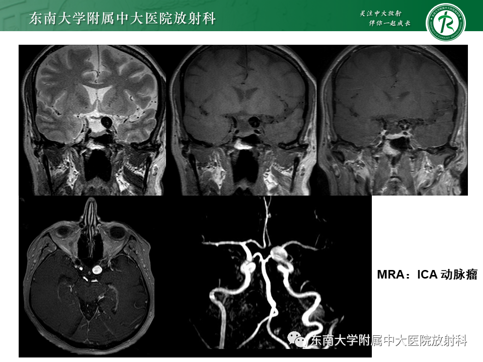 影像PPT - 【PPT】烟雾病-31