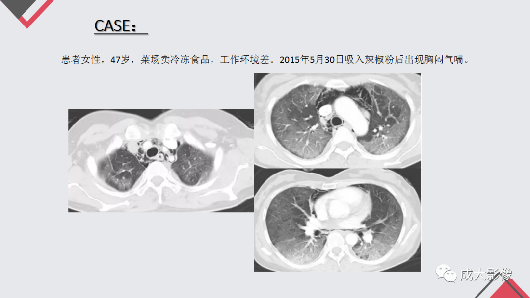 影像PPT - 【PPT】过敏性肺炎-26