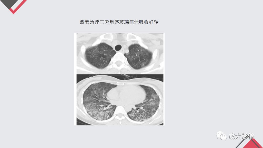 影像PPT - 【PPT】过敏性肺炎-27