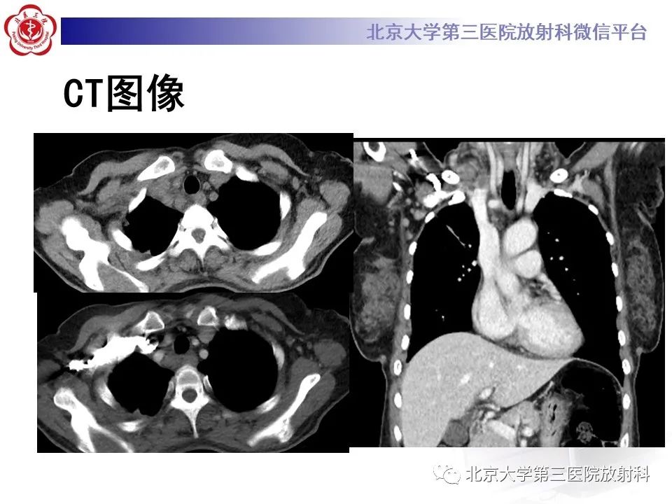 影像PPT - 【PPT】菊池病-3