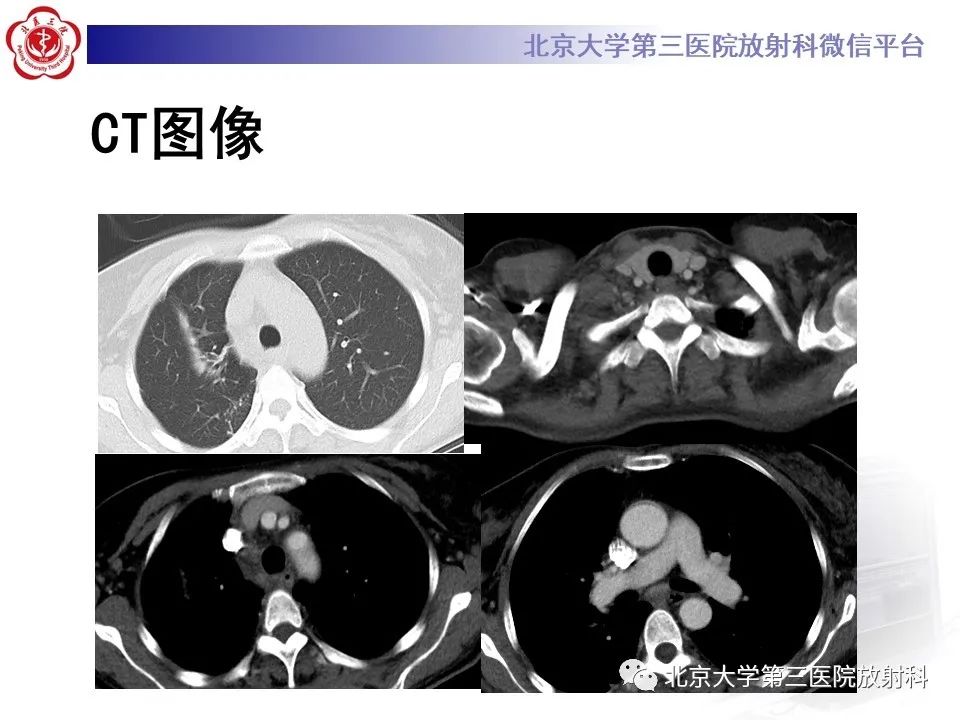 影像PPT - 【PPT】菊池病-4
