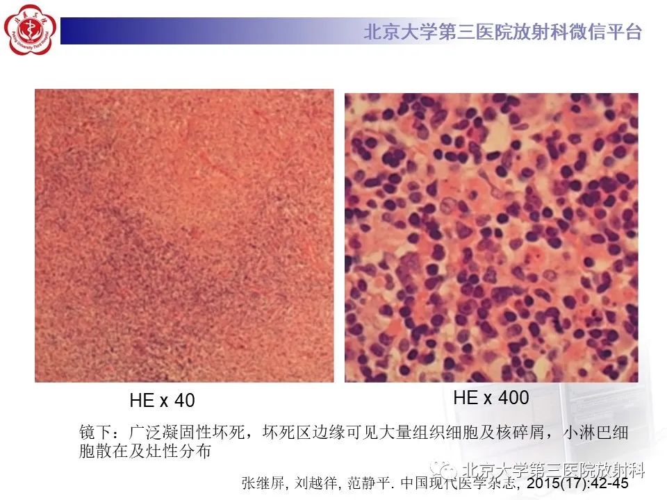影像PPT - 【PPT】菊池病-12