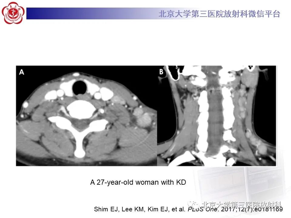 影像PPT - 【PPT】菊池病-15