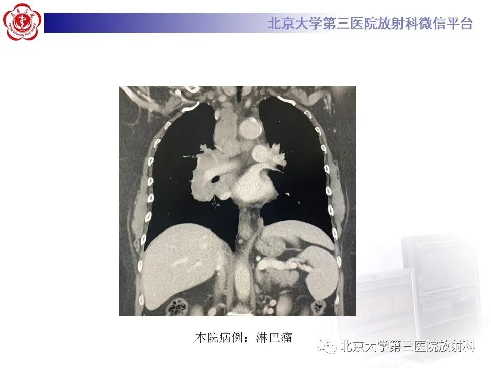 影像PPT - 【PPT】菊池病-19