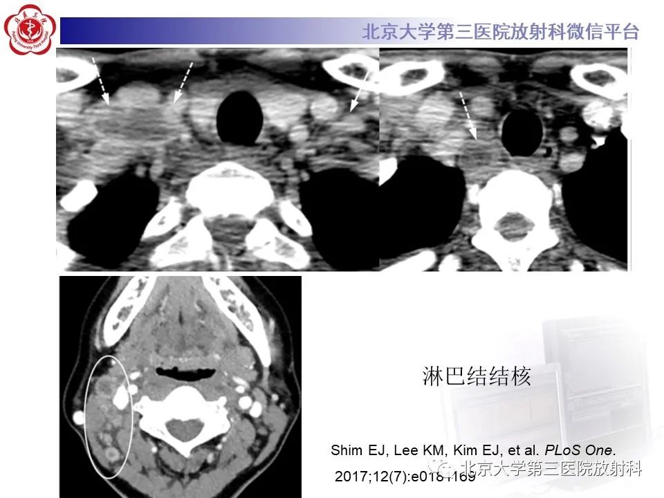 影像PPT - 【PPT】菊池病-21