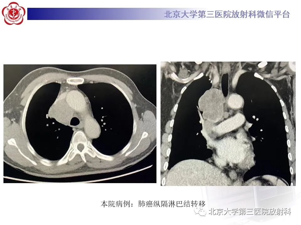 影像PPT - 【PPT】菊池病-23
