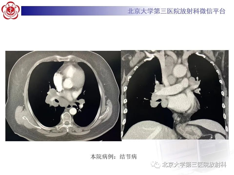 影像PPT - 【PPT】菊池病-25