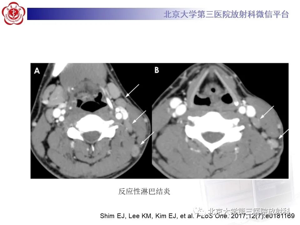 影像PPT - 【PPT】菊池病-29