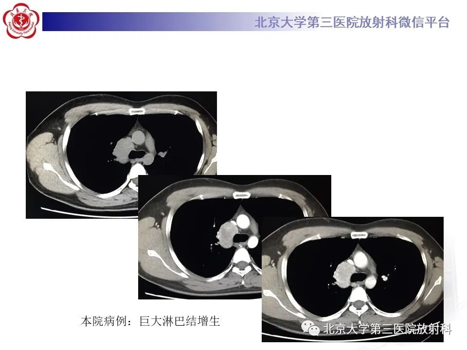 影像PPT - 【PPT】菊池病-27