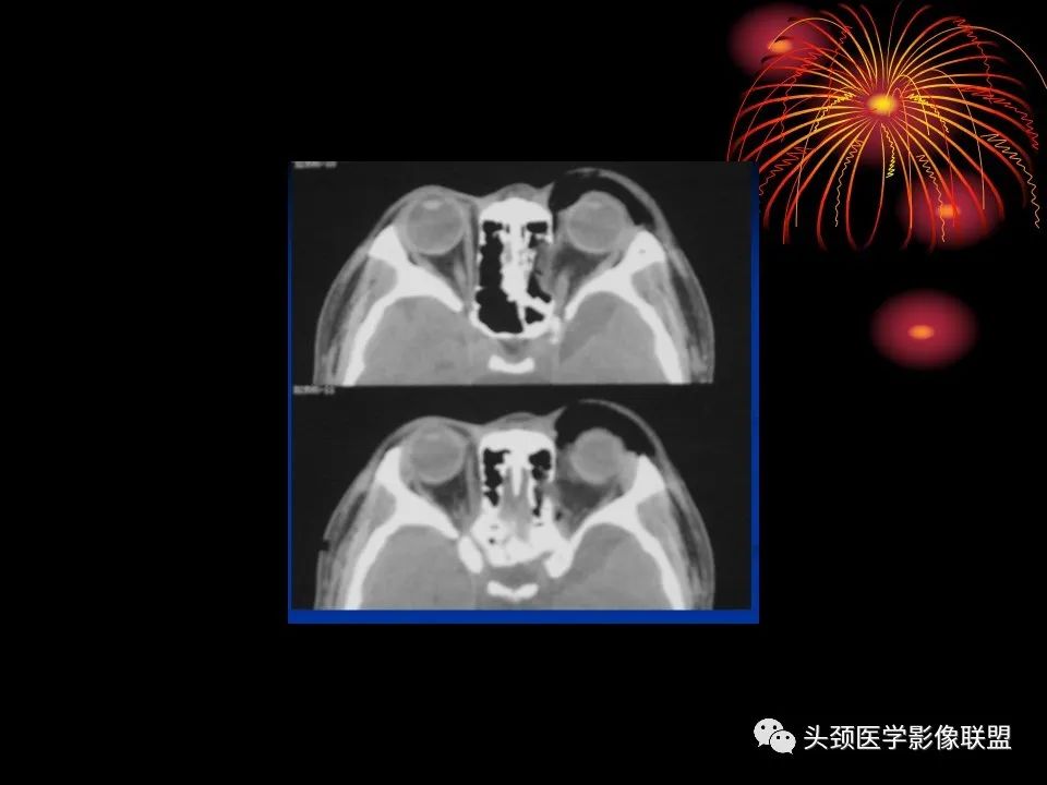 影像PPT - 【PPT】五官影像诊断学-4