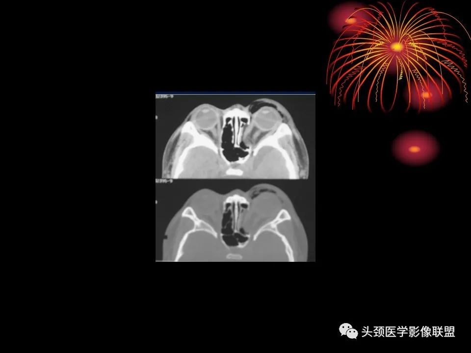 影像PPT - 【PPT】五官影像诊断学-7