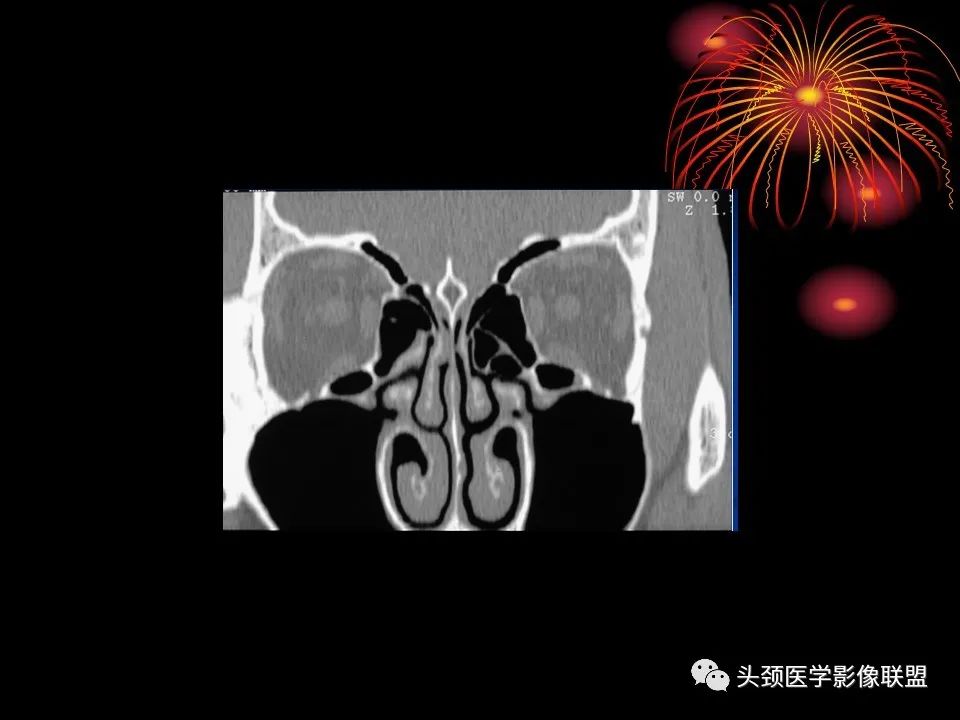 影像PPT - 【PPT】五官影像诊断学-8