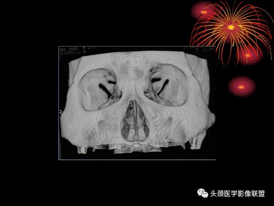 影像PPT - 【PPT】五官影像诊断学-11