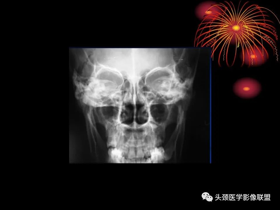 影像PPT - 【PPT】五官影像诊断学-13