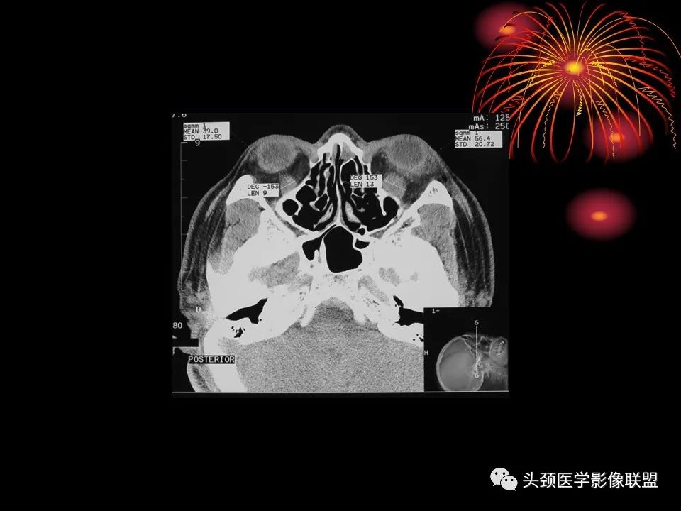 影像PPT - 【PPT】五官影像诊断学-17