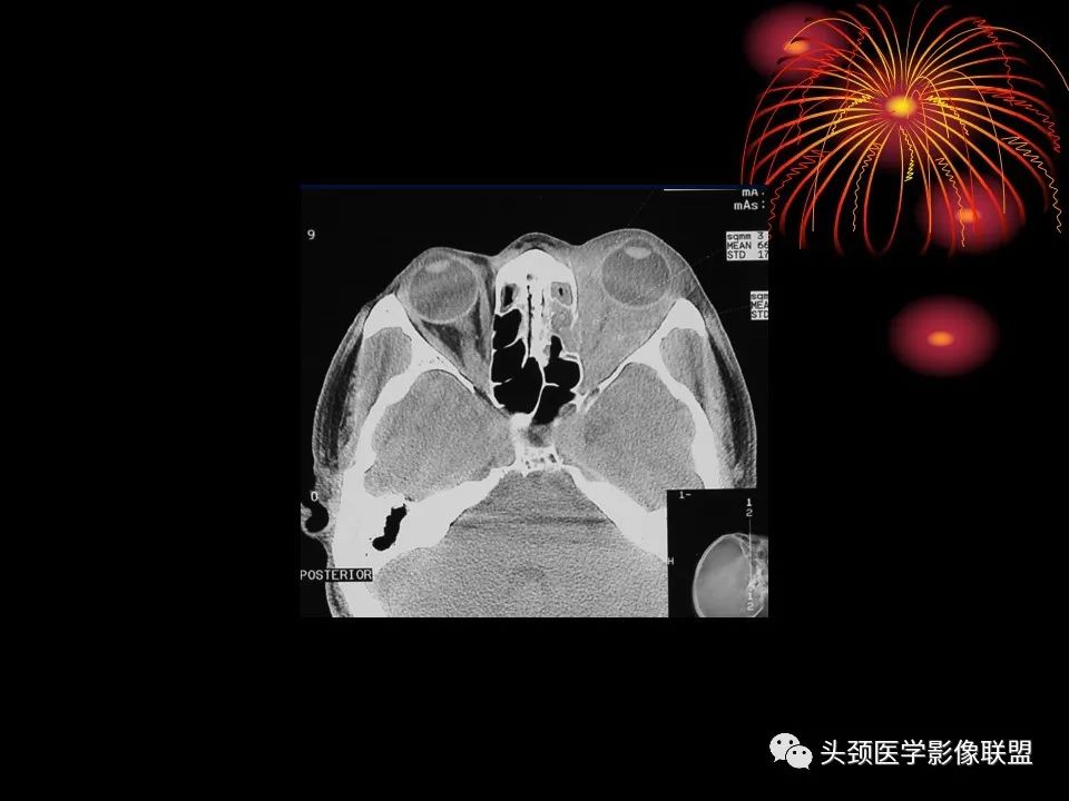 影像PPT - 【PPT】五官影像诊断学-18