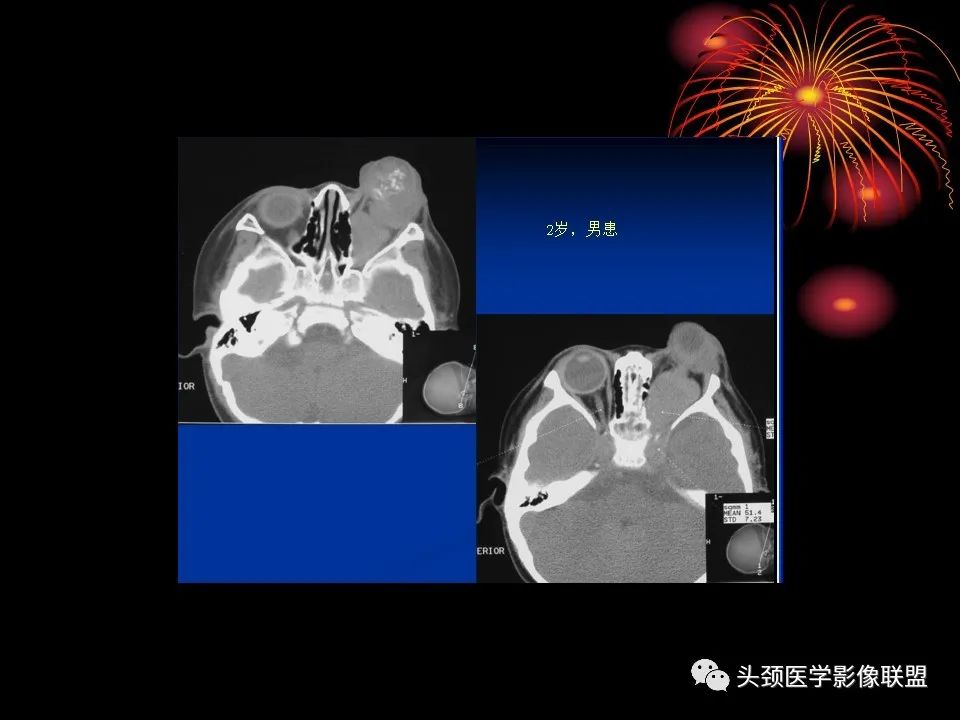 影像PPT - 【PPT】五官影像诊断学-22