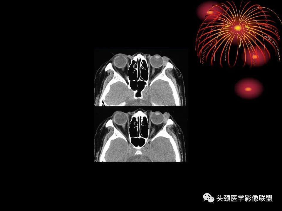 影像PPT - 【PPT】五官影像诊断学-24