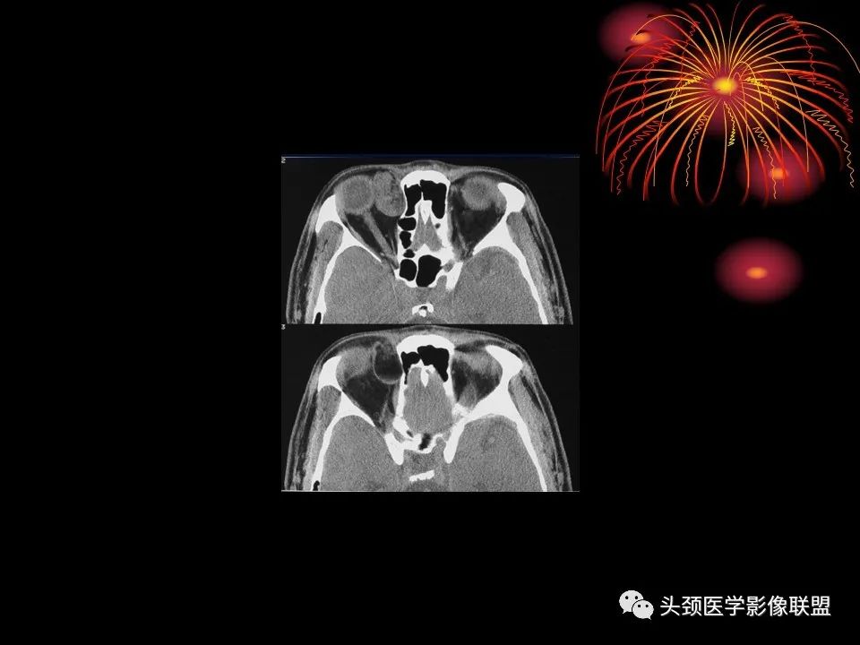 影像PPT - 【PPT】五官影像诊断学-26