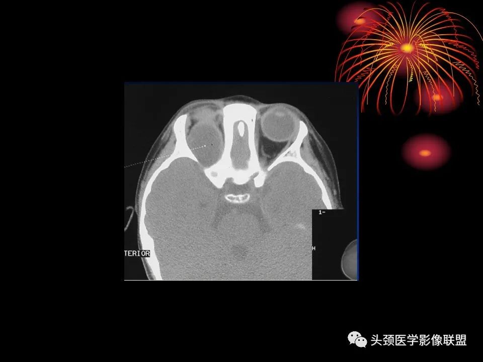 影像PPT - 【PPT】五官影像诊断学-27