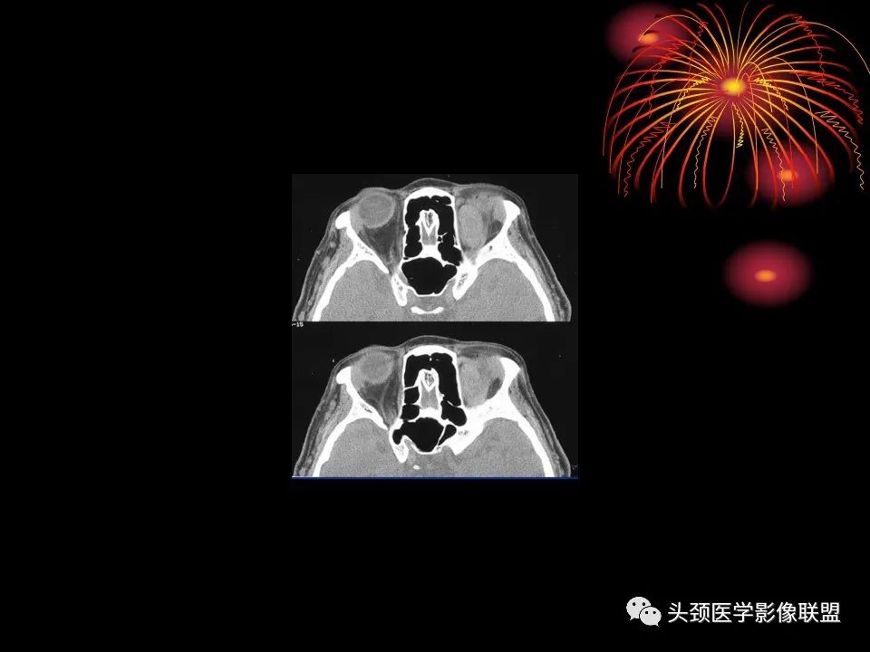 影像PPT - 【PPT】五官影像诊断学-30