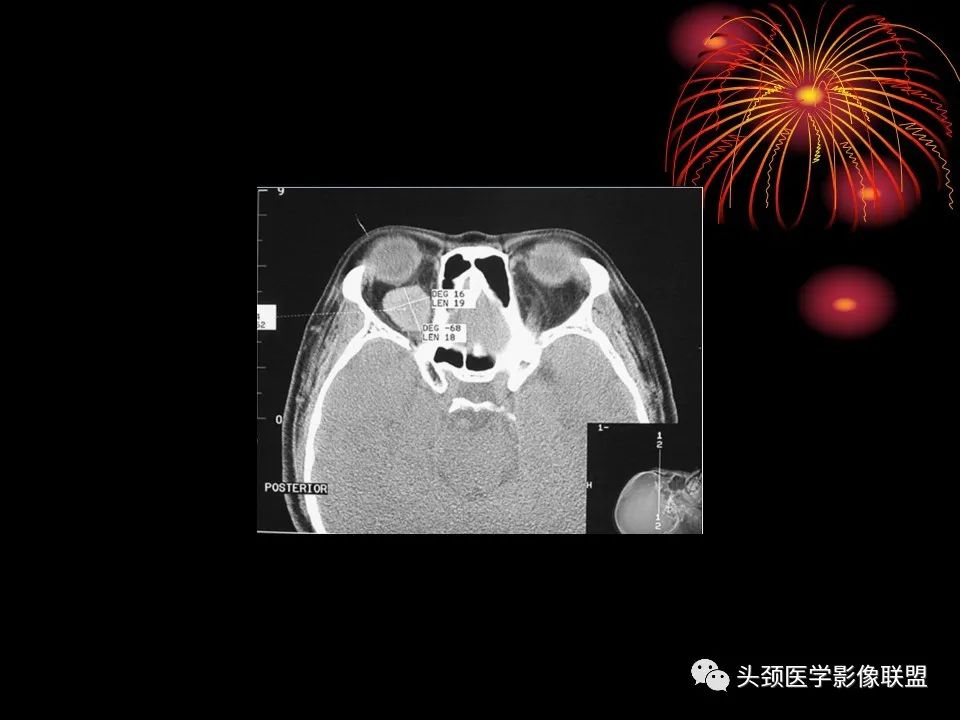 影像PPT - 【PPT】五官影像诊断学-32