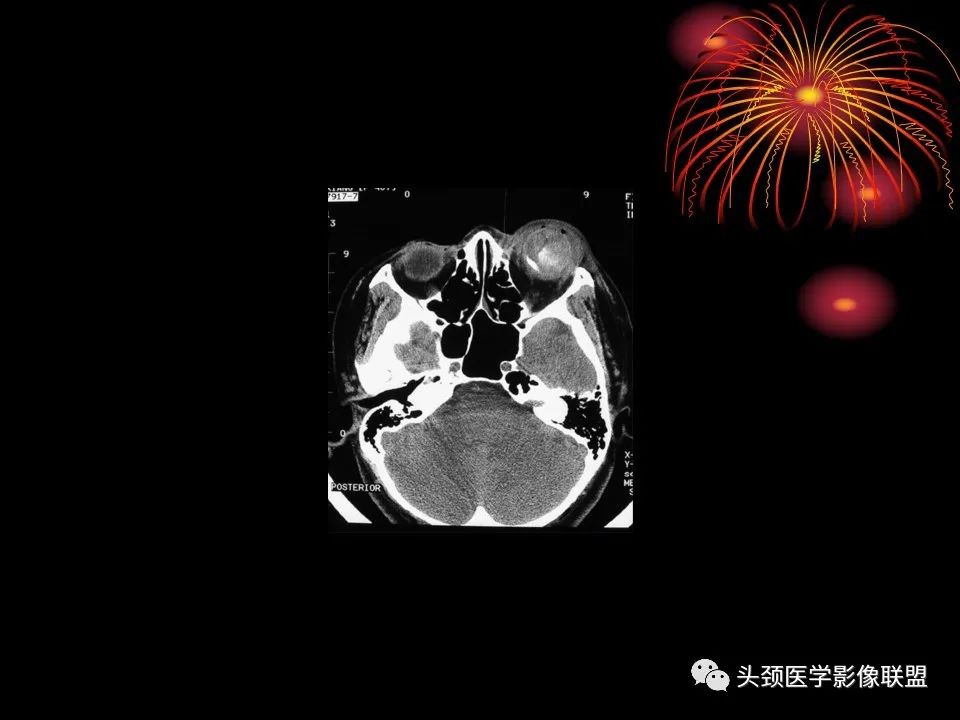 影像PPT - 【PPT】五官影像诊断学-35
