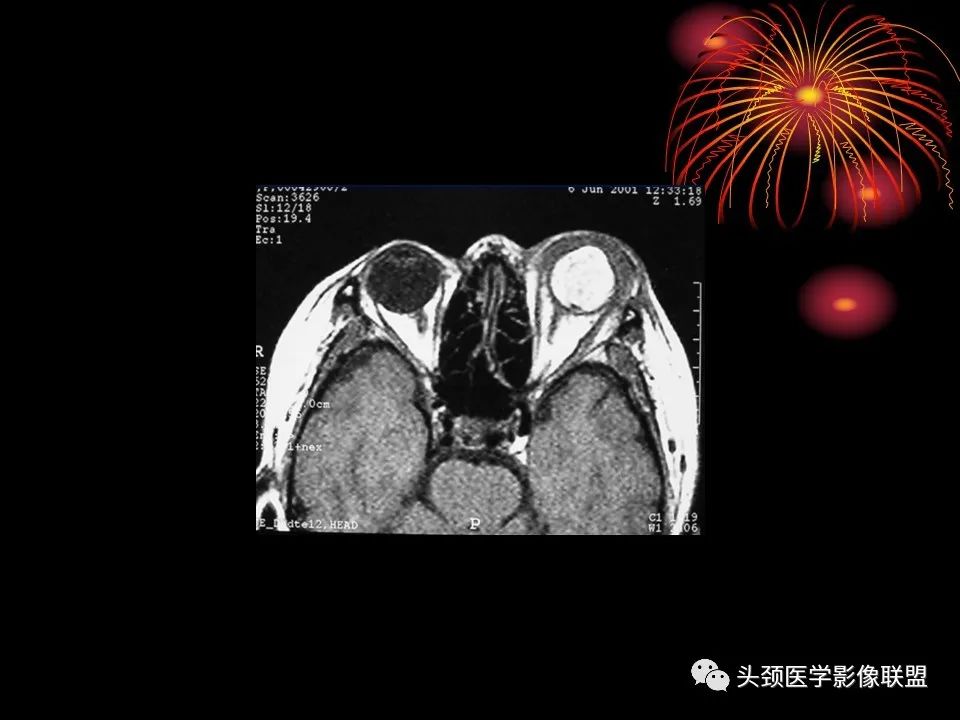 影像PPT - 【PPT】五官影像诊断学-36