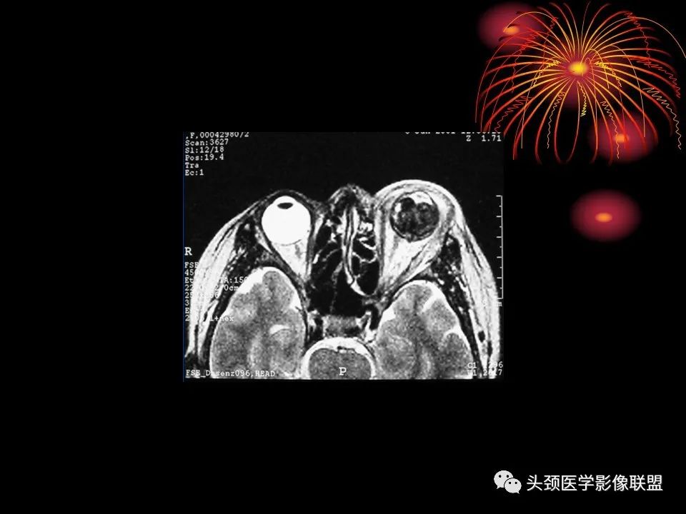 影像PPT - 【PPT】五官影像诊断学-37