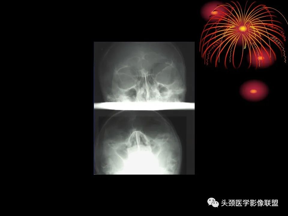 影像PPT - 【PPT】五官影像诊断学-42