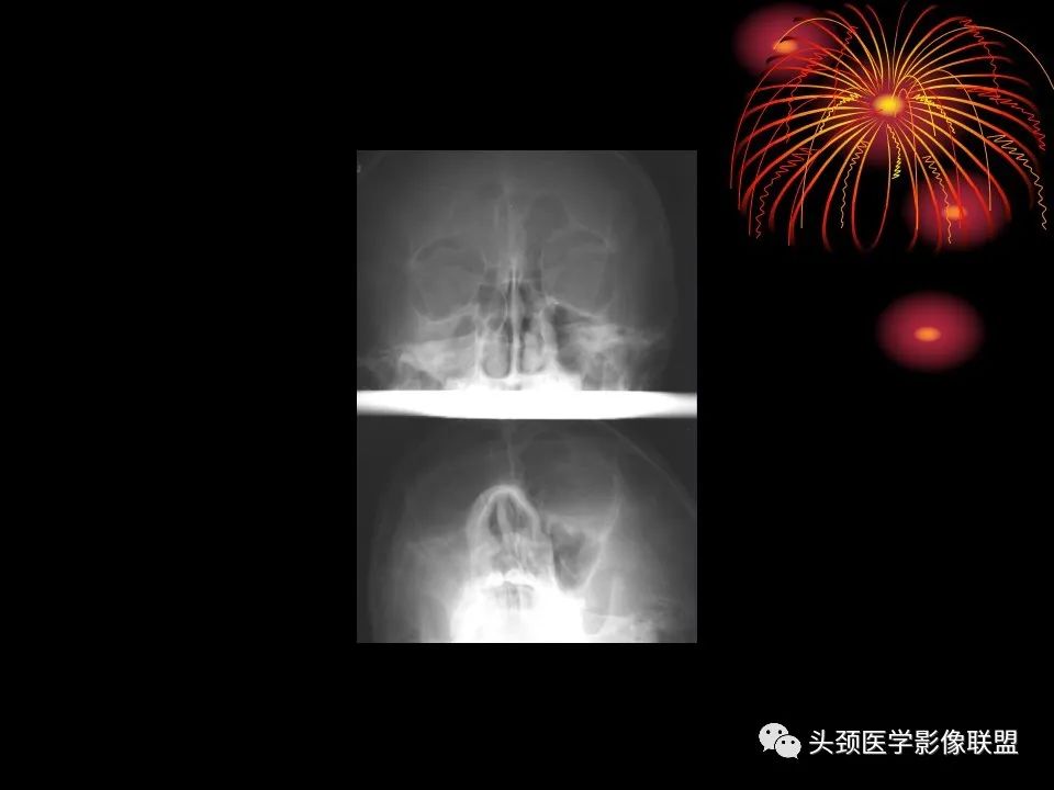 影像PPT - 【PPT】五官影像诊断学-44