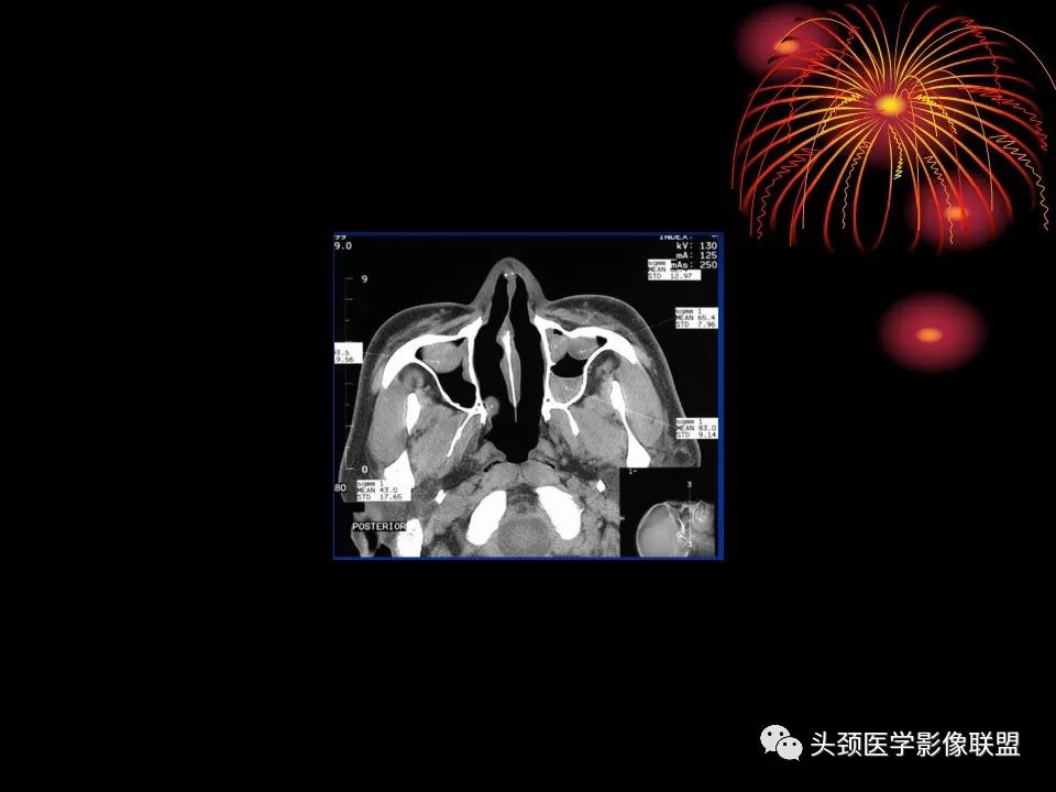 影像PPT - 【PPT】五官影像诊断学-46