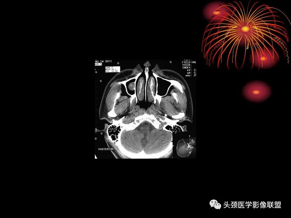 影像PPT - 【PPT】五官影像诊断学-47