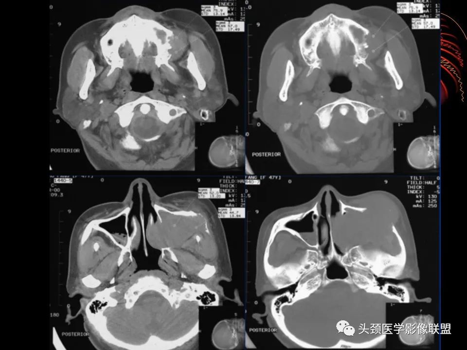 影像PPT - 【PPT】五官影像诊断学-51