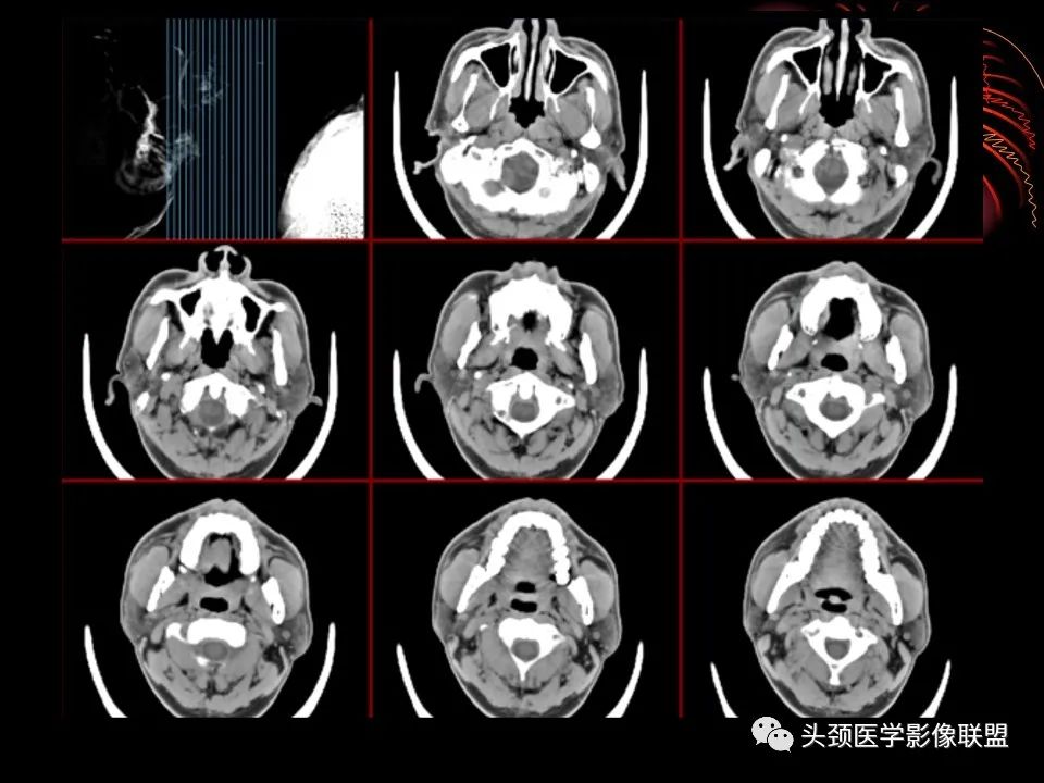影像PPT - 【PPT】五官影像诊断学-57