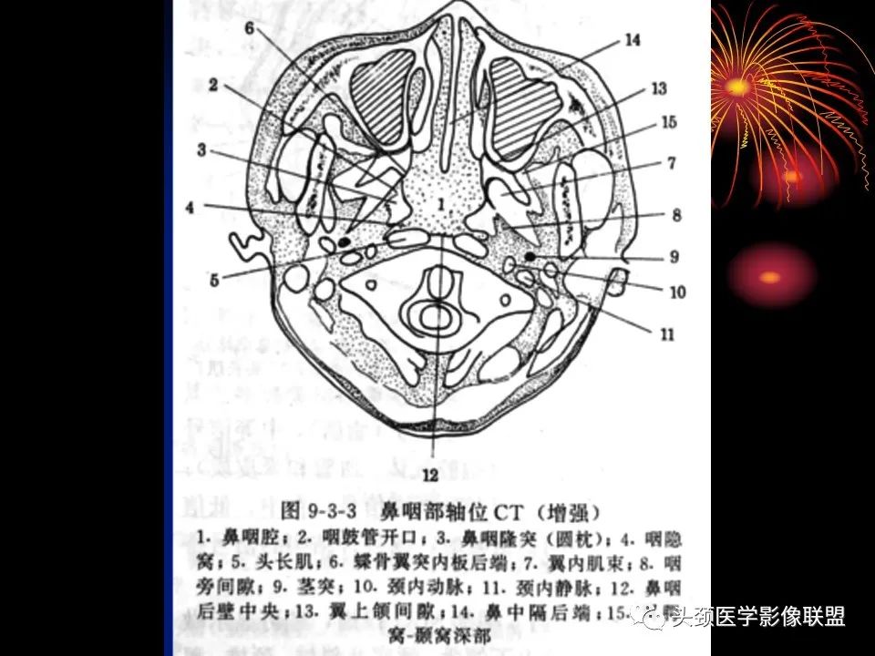 影像PPT - 【PPT】五官影像诊断学-56