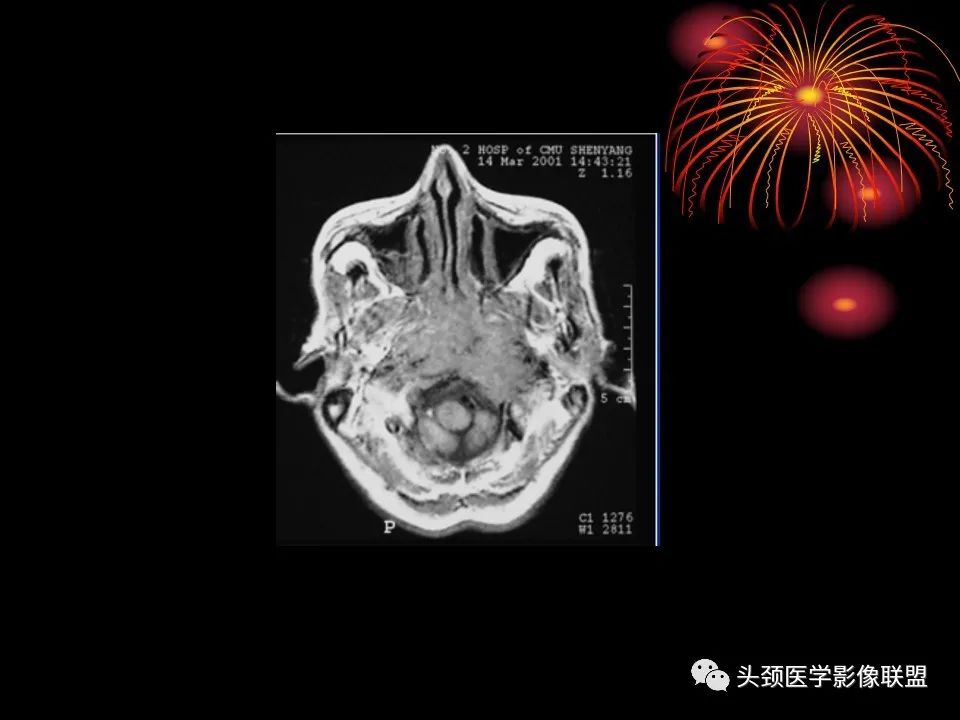 影像PPT - 【PPT】五官影像诊断学-63