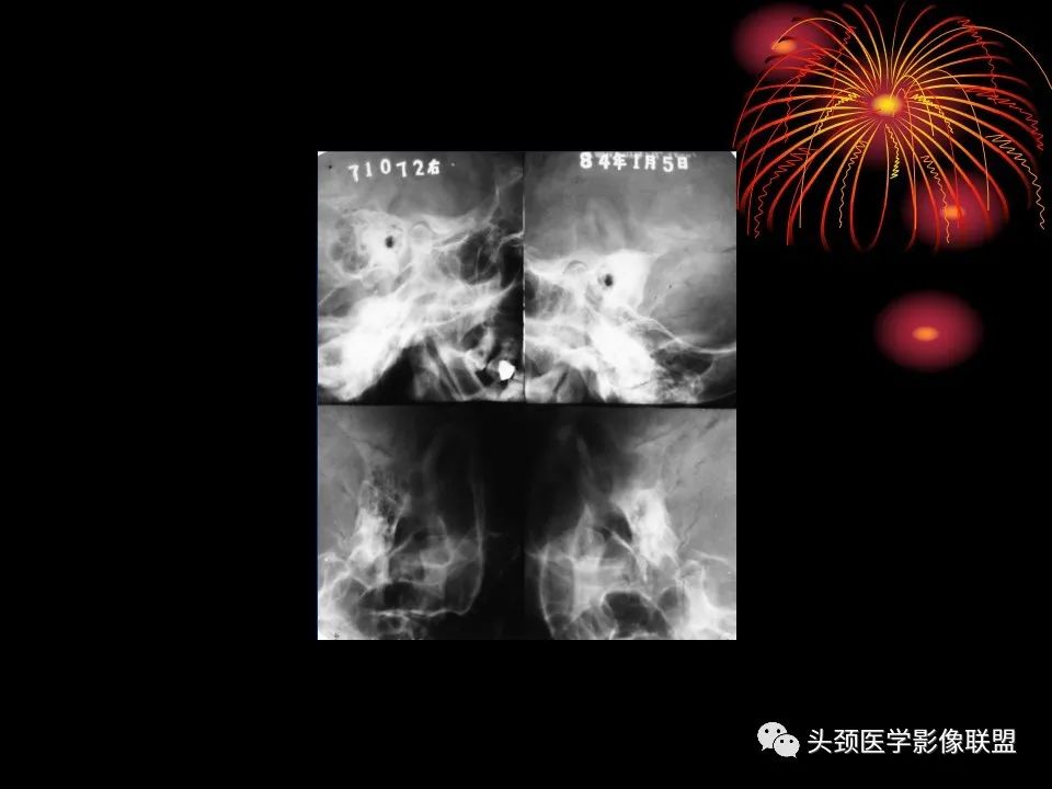 影像PPT - 【PPT】五官影像诊断学-66