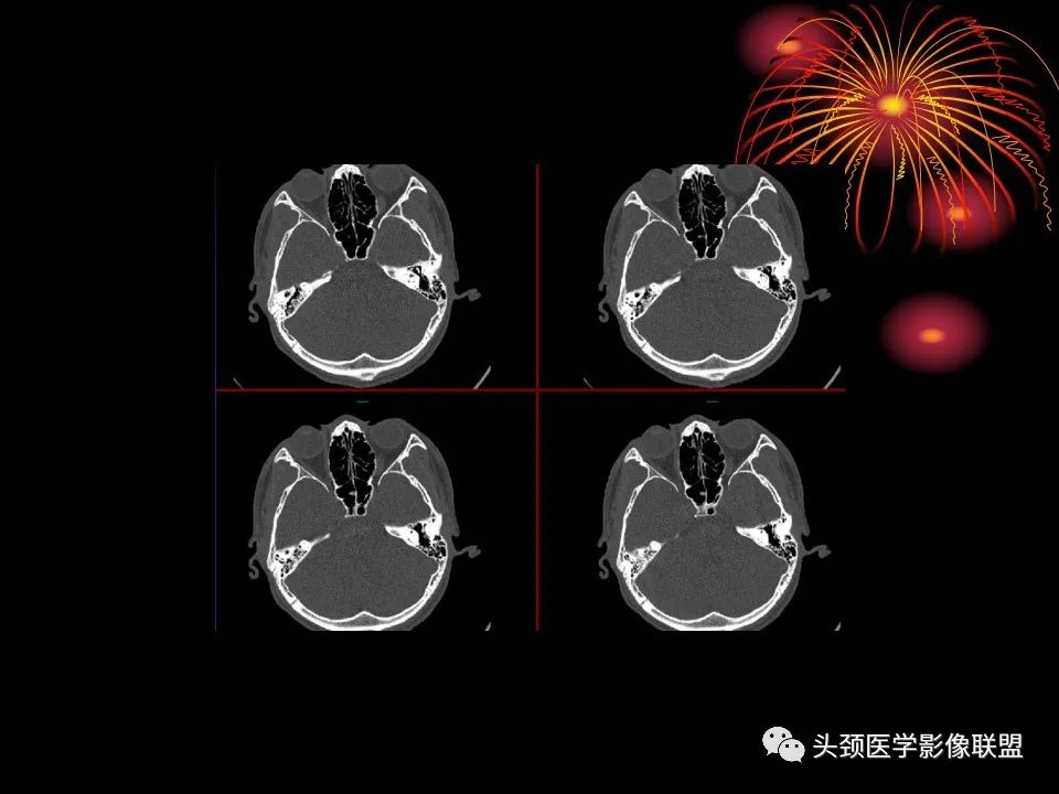 影像PPT - 【PPT】五官影像诊断学-69