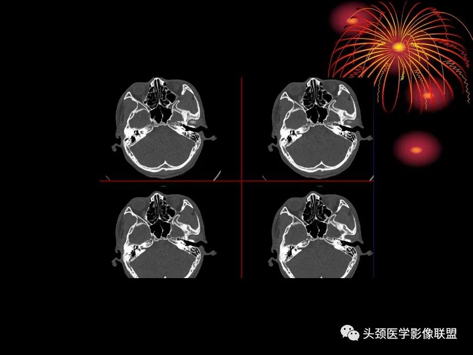 影像PPT - 【PPT】五官影像诊断学-70