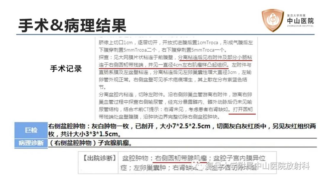 影像PPT - 【病例】子宫腺肌瘤1例MR影像-6