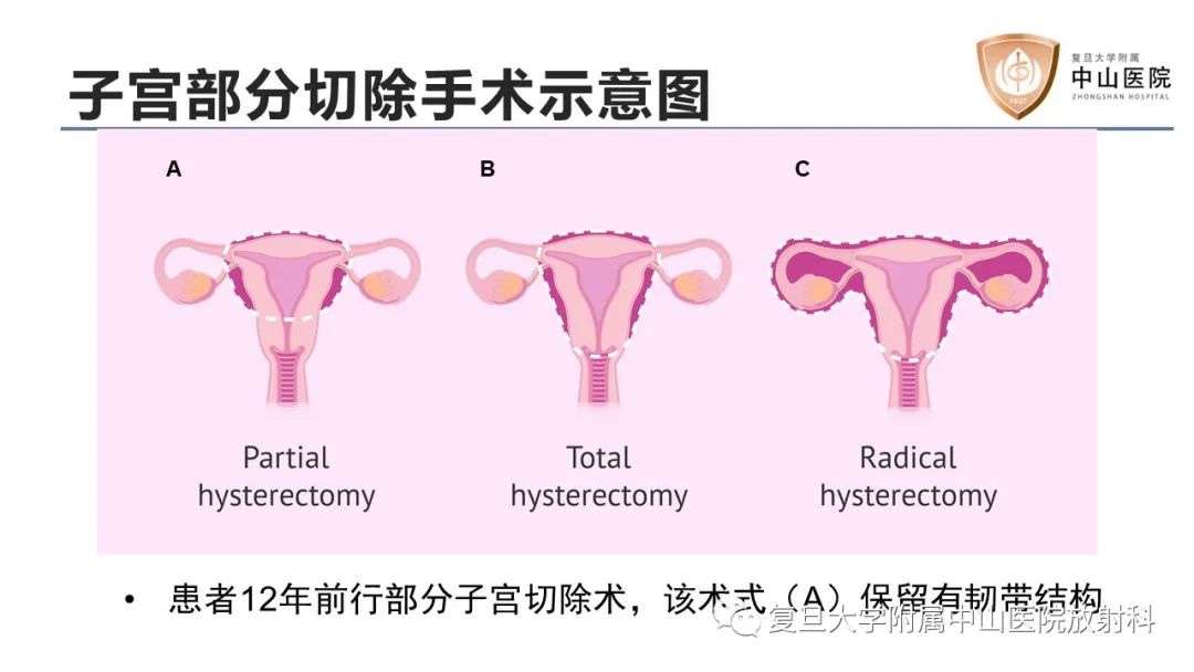 影像PPT - 【病例】子宫腺肌瘤1例MR影像-8