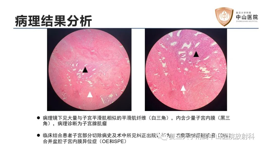 影像PPT - 【病例】子宫腺肌瘤1例MR影像-7