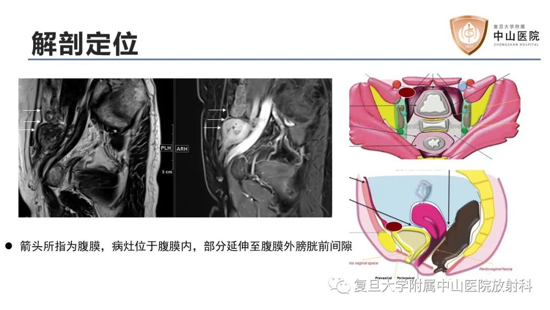影像PPT - 【病例】子宫腺肌瘤1例MR影像-9