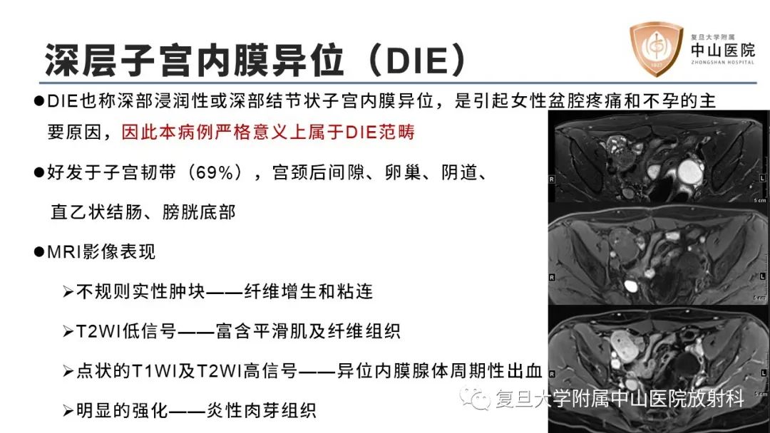 影像PPT - 【病例】子宫腺肌瘤1例MR影像-12