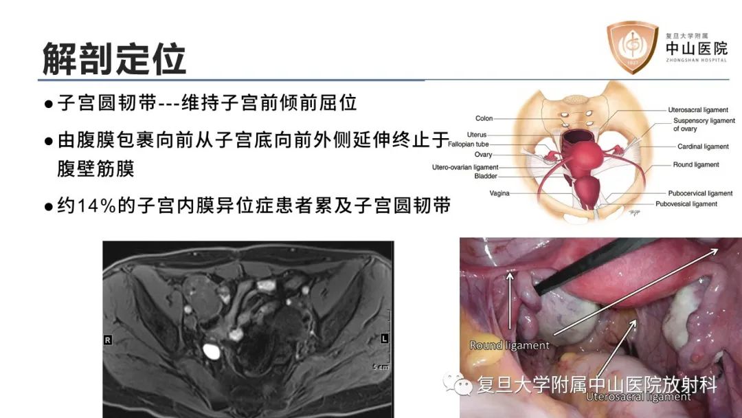 影像PPT - 【病例】子宫腺肌瘤1例MR影像-10