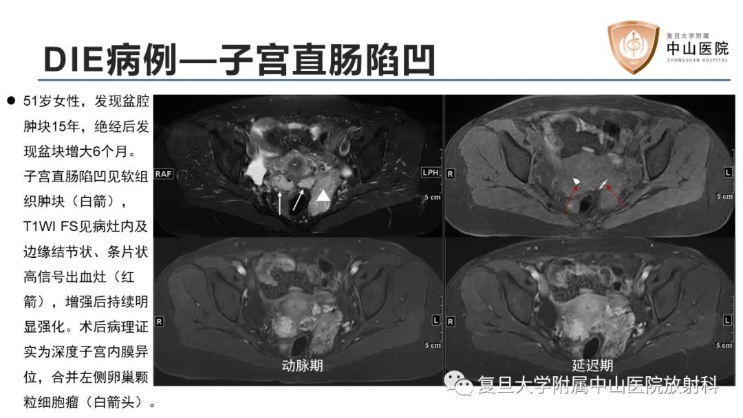 影像PPT - 【病例】子宫腺肌瘤1例MR影像-13