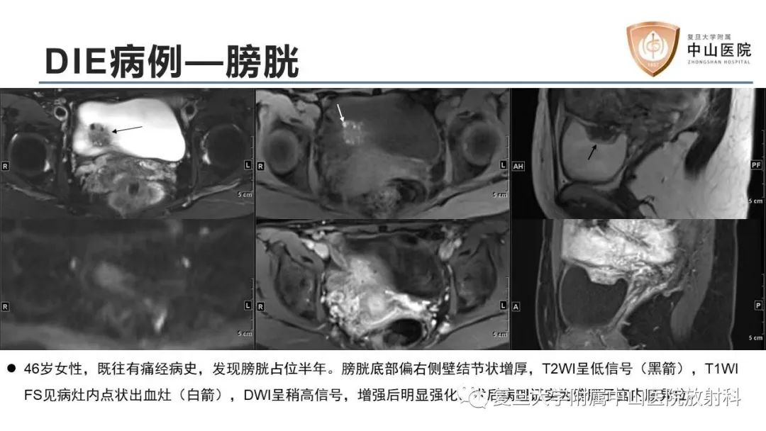 影像PPT - 【病例】子宫腺肌瘤1例MR影像-14